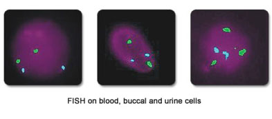 FISH on blood, buccal and urine cells for detection of low grade mosaicism